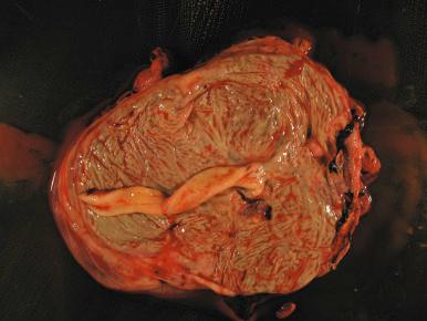 Fig. 31.7, Prolonged meconium staining, umbilical cord, and fetal surface.