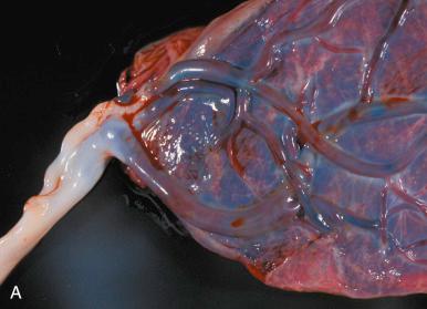 Fig. 31.8, A, Marginal (battledore) cord insertion. B, Membranous (velamentous) cord insertion.