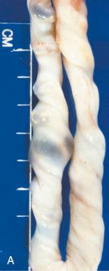 Fig. 31.10, Pinpoint microabscesses resulting from fungal funisitis (A), true knot (B), and false knot (varix; C ).