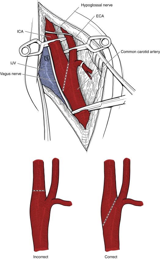 Figure 7-1, Position of Yasargil clamps on carotid arteries. Incorrect ( bottom left ) and correct ( bottom right ) oblique transaction of the internal carotid artery at the carotid bulb.