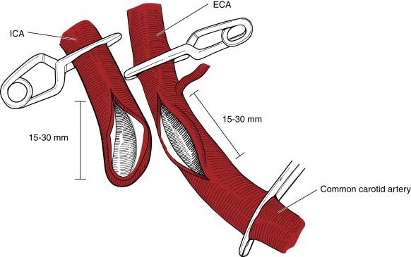 Figure 7-2, Placement of internal carotid artery ( ICA ) and common carotid artery arteriotomies. ECA, External carotid artery.