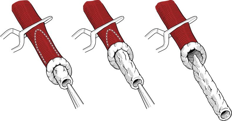 Figure 7-3, Eversion of the internal carotid artery with visualization of the endpoint. The dashed line indicates the extent of atherosclerotic plaque.