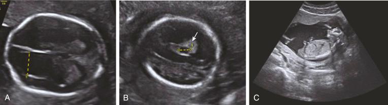 • Fig. 20.1, A, Ventriculomegaly diagnosed by 19-week ultrasound. B, Choroid plexus cyst diagnosed by 20-week ultrasound. Caliper demarcates the cyst, and arrow indicates the choroid plexus. C, Anencephaly diagnosed at 15 weeks.