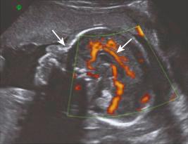 • Fig. 20.2, Twenty-three-week ultrasound image demonstrating nasal bone (left arrow) and corpus callosum with pericallosal artery (right arrow).