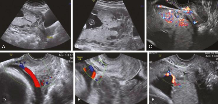 • Fig. 20.3, A–C, Placenta previa with a morbidly adherent placenta. D–F, Vasa previa.