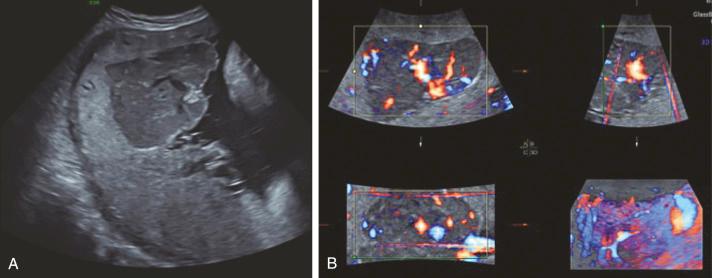 • Fig. 20.4, A, Chorioangioma seen on 36-week ultrasound. B, Colour Doppler demonstrating increased vascularity of chorioangioma.