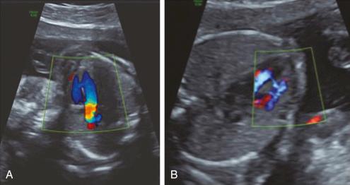 • Fig. 20.5, Colour Doppler demonstrating ventricular septal defect diagnosed on 21-week anatomy ultrasound in apical ( A ) and axial ( B ) views.