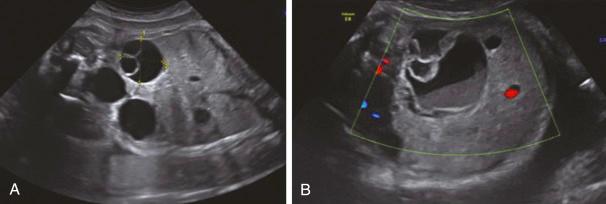 • Fig. 20.6, Fetal pelvic mass in female fetus noted at 29-week ( A ) and 33-week ( B ) ultrasound images.