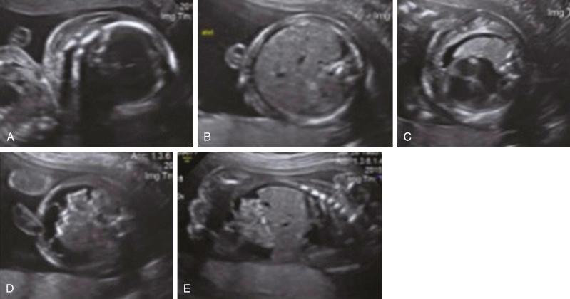 • Fig. 20.7, Fetal hydrops seen on 23-week ultrasound. A, Scalp oedema. B, Abdominal ascites with skin oedema. C, Pleural effusion. D, Abdominal ascites. E, Sagittal section of abdominal ascites.