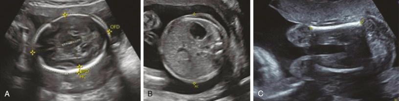 • Fig. 20.8, Standard fetal biometry. Fetal weight can be estimated by obtaining measurements such as biparietal diameter (BPD), head circumference (HC), femoral diaphysis length (FL) and abdominal circumference (AC).