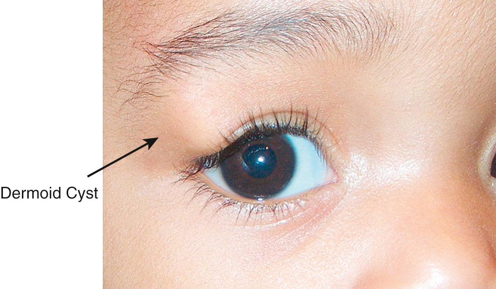 Fig. 95.13, Dermoid cyst in right temporal anterior orbit: Firm, nontender, oval mass palpated.