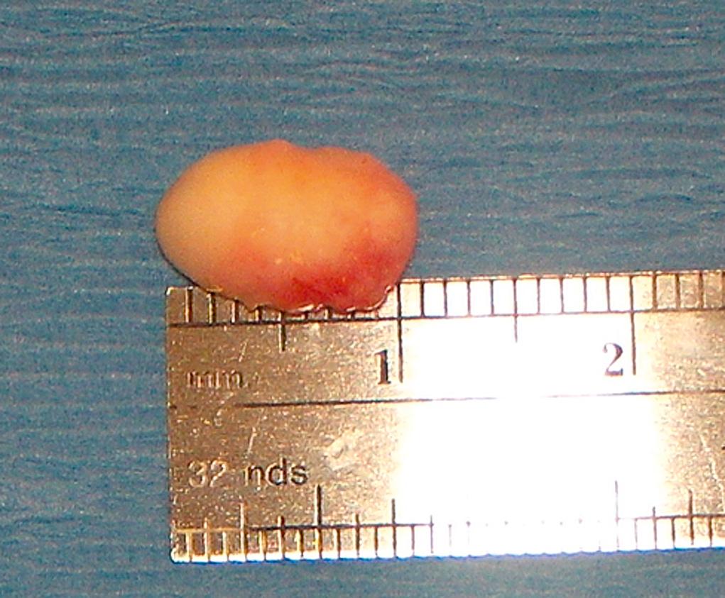 Fig. 95.14, Dermoid cyst removed in total; pathology confirmed diagnosis of dermoid cyst.