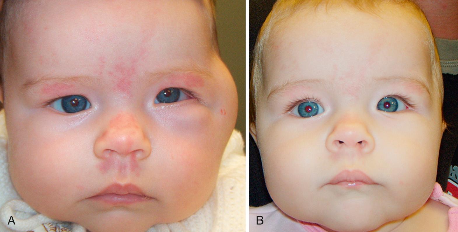 Fig. 95.15, A, Diffuse capillary hemangioma affecting the left side of the face and orbit. B, Resolved hemangioma with oral propranolol treatment.