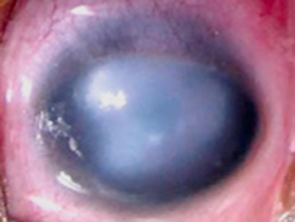 Fig. 95.19, Cloudy cornea: This patient is a 30-week-gestation premature child with Peters anomaly.