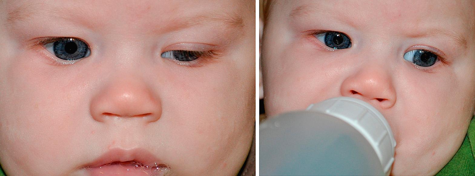 Fig. 95.2, Marcus Gunn jaw wink phenomenon: Left upper lid ptosis seen in the first picture while the left lid raises up as patient sucks from the bottle.