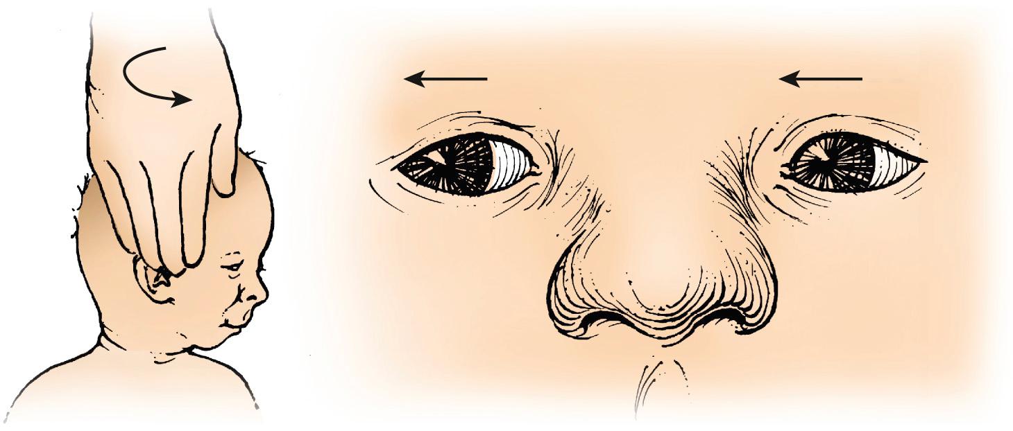 Fig. 95.3, Doll's head rotation: As the head is turned toward the shoulder, a tonic neck muscle reflex produces corresponding ocular rotation in the opposite direction as though the eyes were remaining in their original position as the head moves.