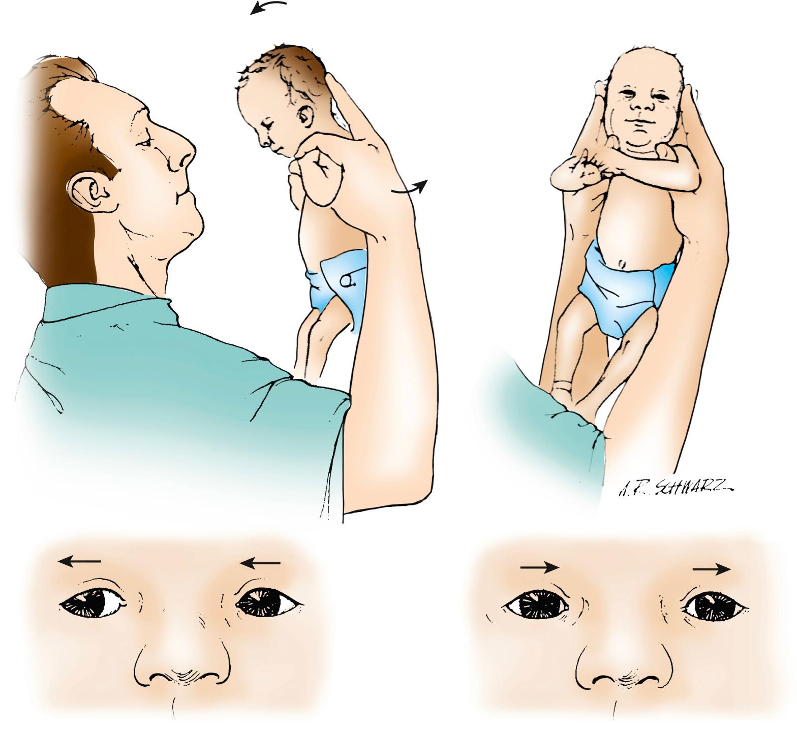 Fig. 95.4, Rotational nystagmus: The infant's head is inclined slightly forward with eyes open. With rotation, the eyes move in the opposite direction as in a doll's eye rotation. When rotation stops, the recovery movement occurs in the reverse direction.