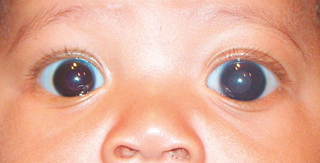 Fig. 95.5, Congenital glaucoma: Left eye larger than the right eye with grayish discoloration secondary to corneal edema in the left eye.
