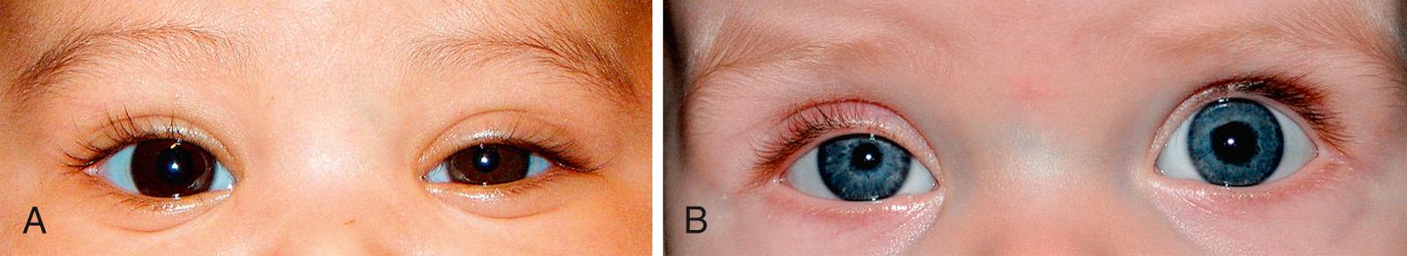 Fig. 95.6, A, Congenital Horner syndrome affecting the left side: Note the smaller left pupil, the mild left upper lid ptosis, the left lower lid reverse ptosis and heterochromia (left eye lighter brown while right eye dark brown). B, Horner syndrome affecting right side: Note right pupil smaller than the left and mildly droopy right upper lid.