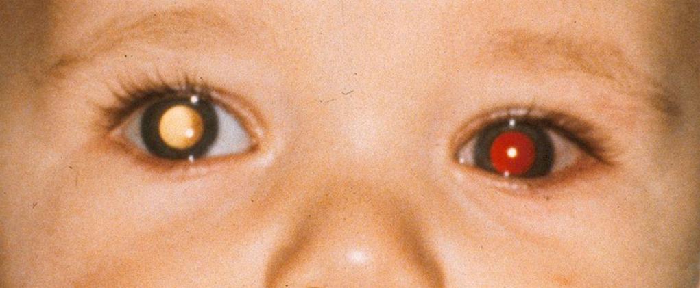 Fig. 95.7, Red reflex: Normal red reflex in the left eye and a white reflex in the right eye. This patient was later diagnosed with retinoblastoma in the right eye.