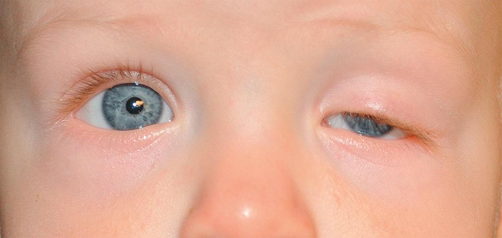 Fig. 95.9, Congenital ptosis of the left upper lid.