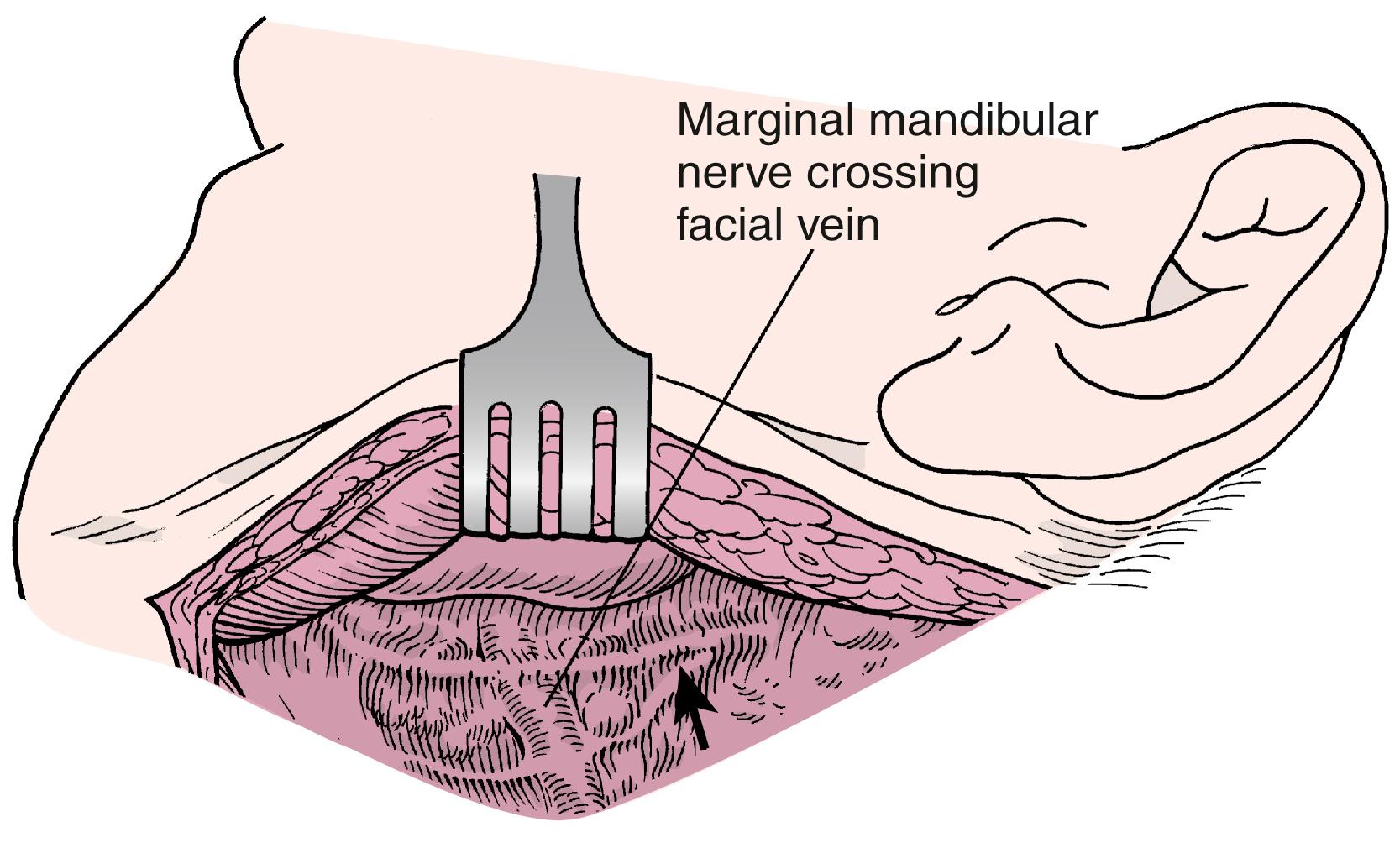 Fig. 91.2, Exposure of the submandibular gland by elevating the platysmal muscle with the skin flap. Note the position of the marginal mandibular nerve (arrow) .
