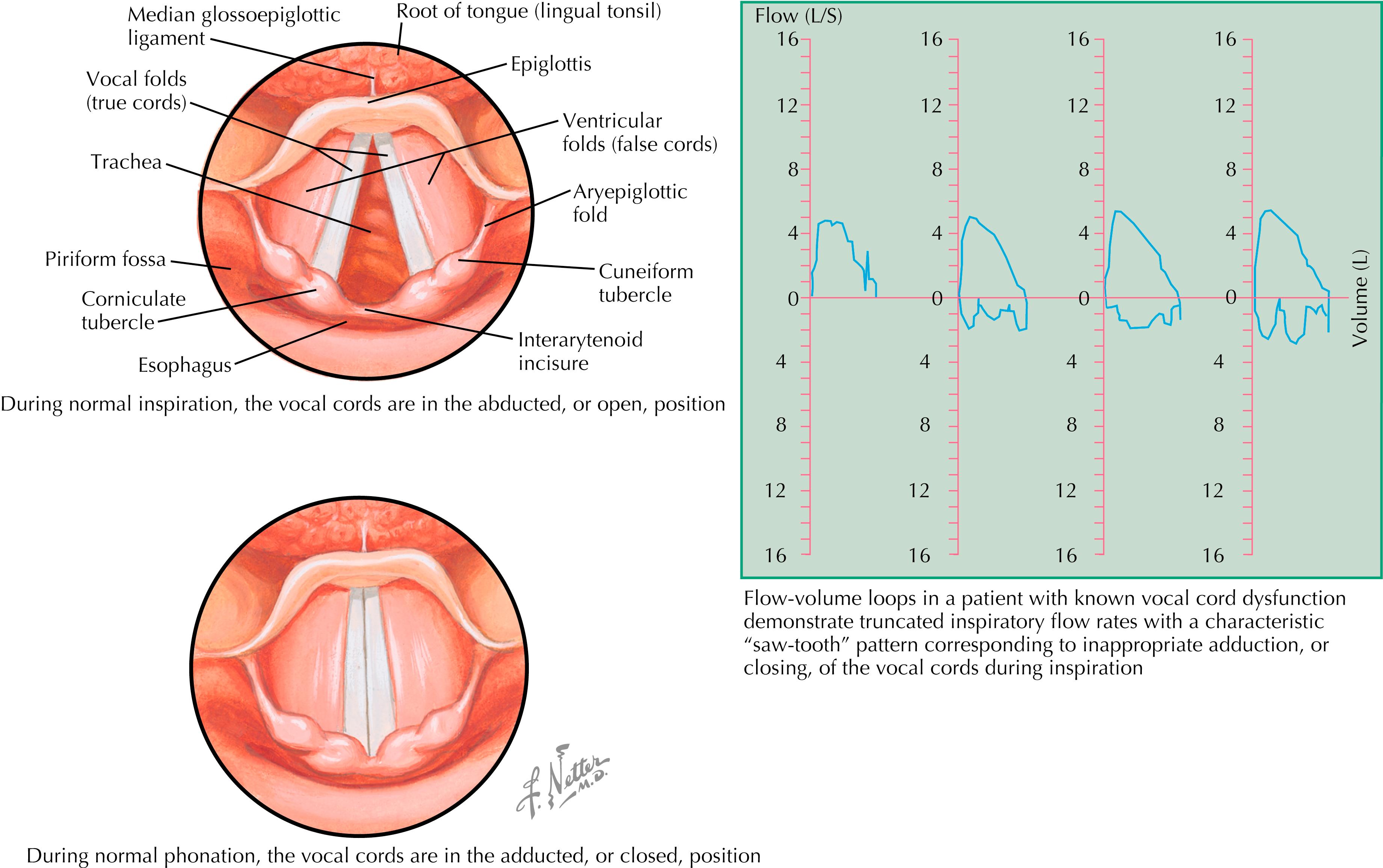 Figure 37.1, Vocal cord dysfunction.