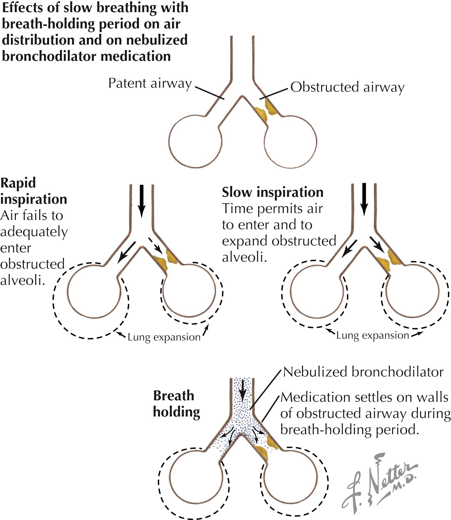 Figure 37.2, Bronchospasm.