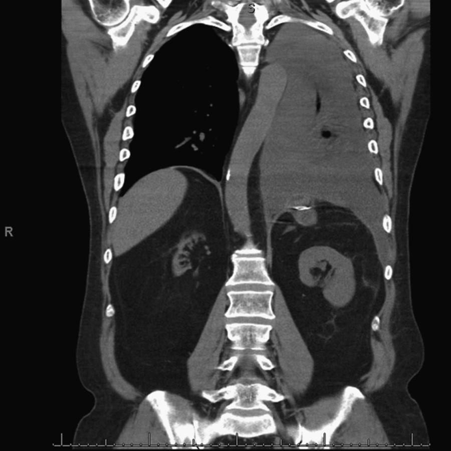 Fig. 56.11, Massive left-sided pleural effusion secondary to a pancreaticopleural fistula.