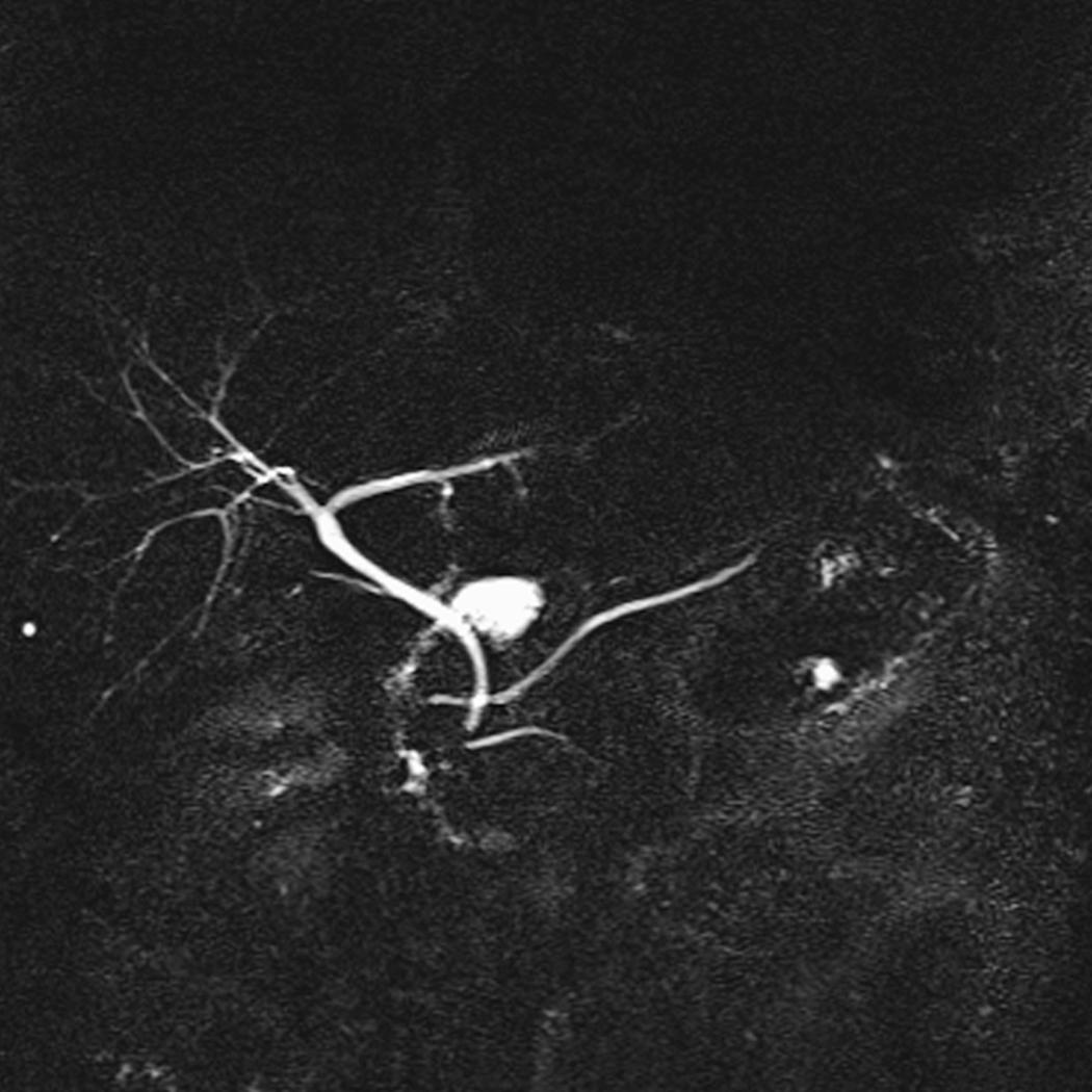 Fig. 56.4, MRCP showing pancreas divisum, with the dorsal pancreatic duct draining through the minor papilla and the ventral pancreatic duct joining the biliary tree draining through the major papilla. MRCP , Magnetic resonance cholangiopancreatography.