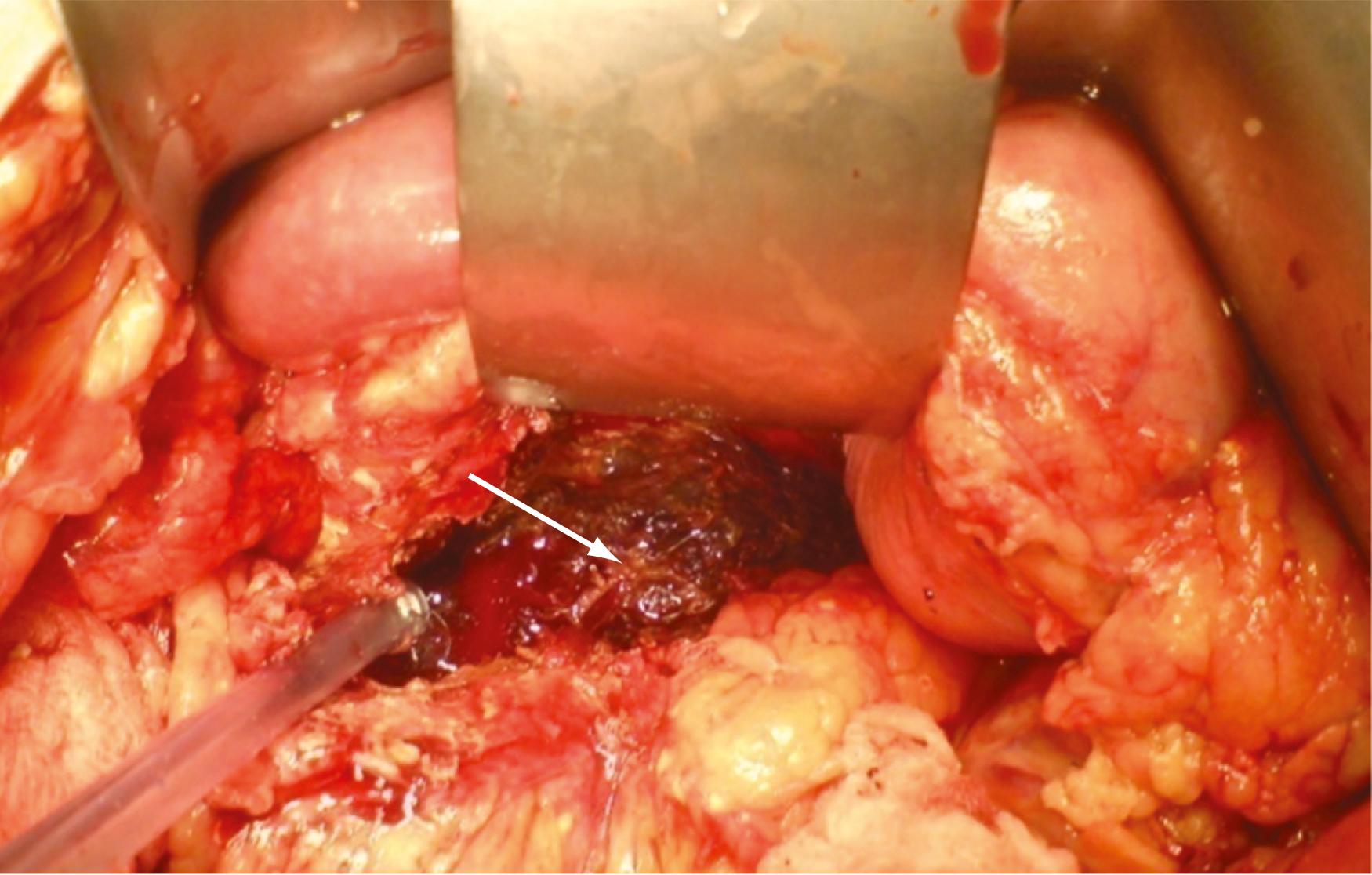 Fig. 56.9, Infected pancreatic necrosis. This 45-year-old man had severe ethanol-induced pancreatitis. Four weeks after the initial episode, the patient developed fever (39.5°C [103°F]), hypotension, and leukocytosis (19,000 cells/mm 3 ). The computed tomography (CT) scan documented pancreatic necrosis involving 35% of the gland. After fine-needle aspiration (FNA), Gram staining documented the presence of gram-negative rods. The exploratory laparotomy indicated pancreatic necrosis involving mainly the body of the gland (arrow). The patient was treated with necrosectomy, closed drainage, and intravenous meropenem. Final culture documented the presence of Escherichia coli . The patient was discharged home 56 days after the initial episode.