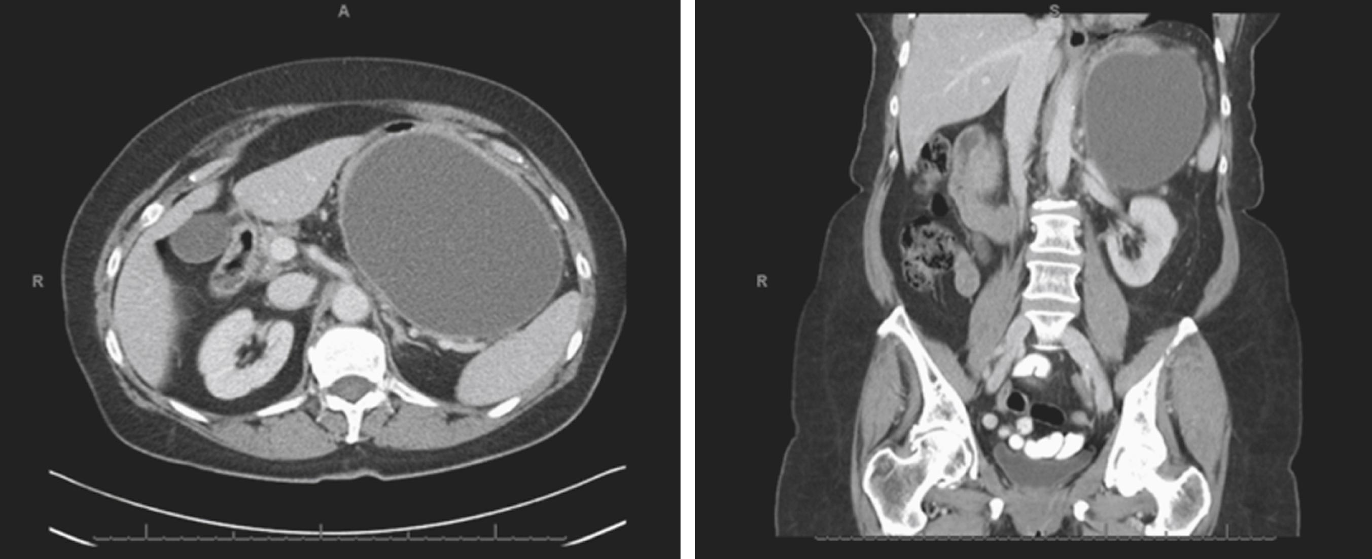 Fig. 56.10, Computed tomography (CT) scans showing a large pseudocyst arising in the tail of the pancreas.