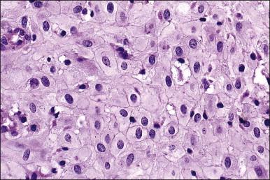 Figure 15.12, Combined OC (Loestrin) with well-developed decidual change (high magnification).