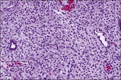 Figure 15.14, Decidualized endometrium with long-term Depo-Provera use.