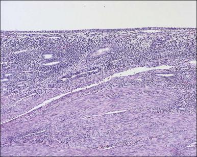 Figure 15.2, Atrophic endometrium. The few glands present have minimal cytoplasm and small nuclei. The endometrial stroma is dense.