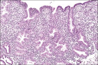 Figure 15.5, Secretory endometrium, demonstrating exogenous progesterone effect. The appearance is indistinguishable from a normal cycle. The woman, who was older, had received progesterone for 20 days.