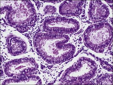 Figure 15.6, Vacuolated secretory glandular changes in response to short-term progestin therapy.