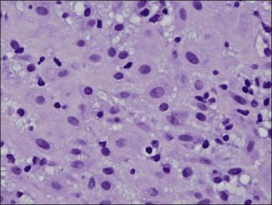 Figure 15.7, Stromal pseudodecidualization, response to progesterone therapy.