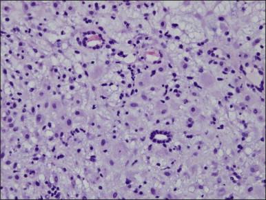 Figure 15.8, Atrophic gland in decidualized stroma in a woman receiving progesterone.