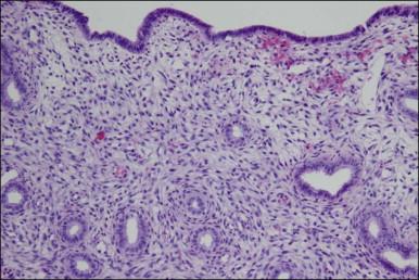 Figure 15.9, Gland atrophy with combined OC. The stromal decidual response is minimal.