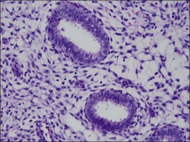 Figure 15.10, Combined OC, secretory exhaustion. The glands are small and show only rudimentary evidence of secretory activity in the form of apical snouts.