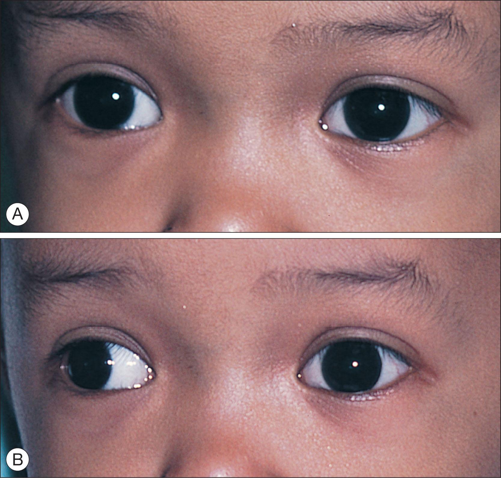 Fig. 11.7.1, Intermittent Exotropia.