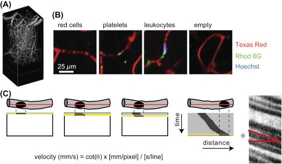 Figure 71.1, (A) Three-dimensional rendering of cortical blood vessels in mouse brain imaged with two-photon microscopy. Vessels were visualized by injecting dextran-conjugated fluorescent dye. Adapted from Kobat D, Durst ME, Nishimura N, Wong AW, Schaffer CB, Xu C. Deep tissue multiphoton microscopy using longer wavelength excitation. Opt Express 2009;17:13354–64 . (B) Fluorescent labels used to provide cellular information. Blood cells show up as dark areas when the blood plasma is labeled with intravenous dye injections ( red , Texas Red dextran). Red blood cells, nucleated white blood cells, and platelets can be distinguished with injections of rhodamine 6G ( green ) and Hoechst ( blue ). Adapted from Santisakultarm TP, et al. Stalled cerebral capillary blood flow in mouse models of essential thrombocythemia and polycythemia vera revealed by in vivo two-photon imaging. J Thromb Haemost 2014;12: 2120–30. http://dx.doi.org/10.1111/Jth.12738 . (C) A schematic and example data showing line-scans. The excitation laser is repeatedly scanned along a vessel. The motion of cells produces streaks in the line-scans. The angle of the streaks is related to the speed of the cell motion.