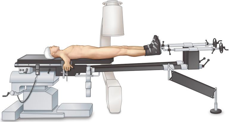 Fig. 13.1, The patient is positioned supine on a radiolucent fracture table. The arms are abducted and intraoperative image intensification is positioned on the contralateral side.