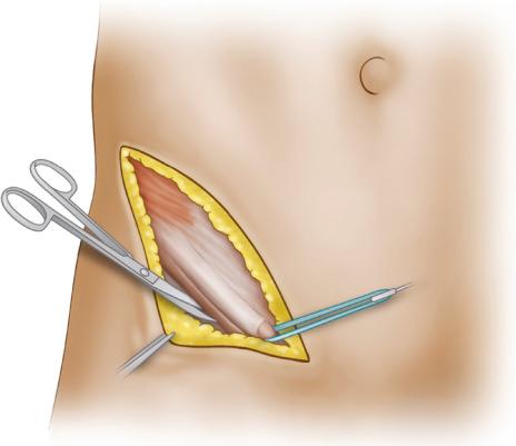 Fig. 13.5, The fibers of the external abdominal oblique are split 4 to 5 mm proximal to their insertion on the inguinal ligament distally to a point just distal to the external inguinal ring.