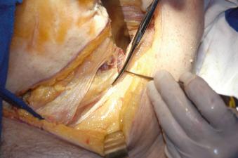 Fig. 13.6, The conjoined tendon of the transversus abdominis and the internal abdominal oblique is incised 2 to 3 mm from their insertion on the inguinal ligament, leaving an adequate amount of tendon on each side for repair during closure.