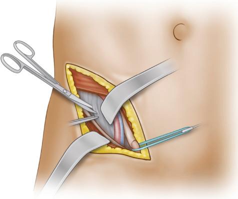 Fig. 13.8, Dissection medial to the iliopectineal fascia mobilizes the external iliac vessels, and a Deaver retractor is used to retract the vessels as the iliopectineal fascia is split to the pelvic brim.