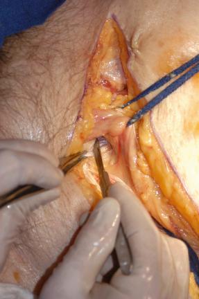 Fig. 13.9, Dissection beneath the spermatic cord allows transection of the rectus abdominis tendon on the operative side.