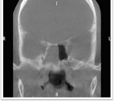 Fig. 16.1, Coronal CT image demonstrating extensive bony osteitis of the right sphenoid sinus compared to the left.