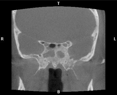 Fig. 16.2, Coronal CT image demonstrating bilateral chronic sphenoiditis with associated bony thickening.